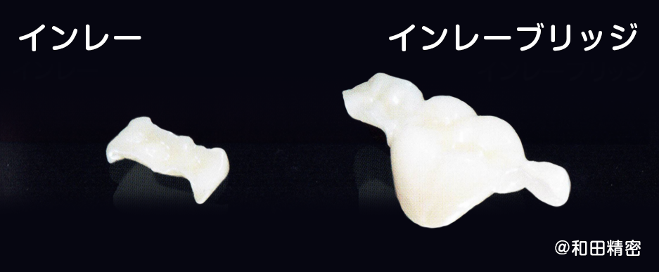 インレー・インレーブリッジ
