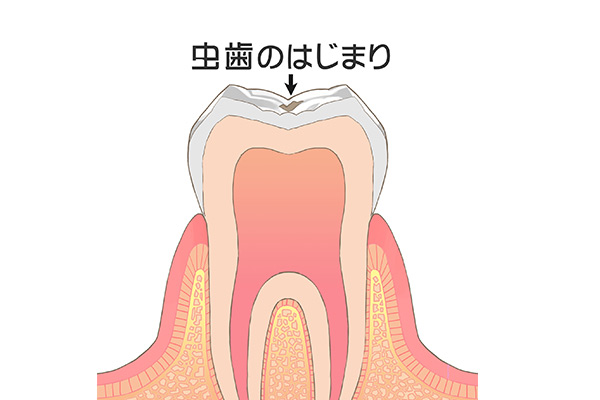 歯が失われていく仕組み
